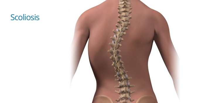 Scoliosis reduced by Chiropractic Care Reprinted By Dr. John Boyer Chiropractor